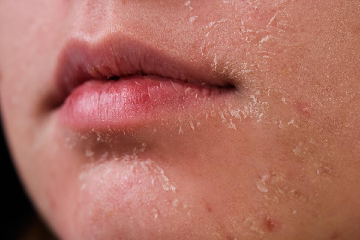Da mặt khô rất dễ bị bong tróc