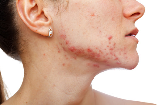 Mụn viêm đỏ do vi khuẩn P.acnes gây ra